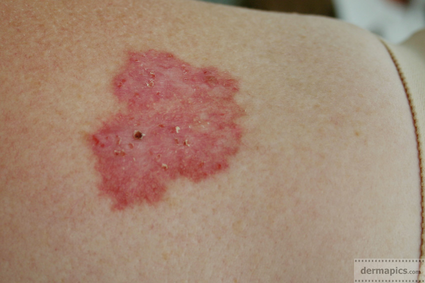 Five Warning Signs of Basal Cell Carcinoma - SkinCancer.org