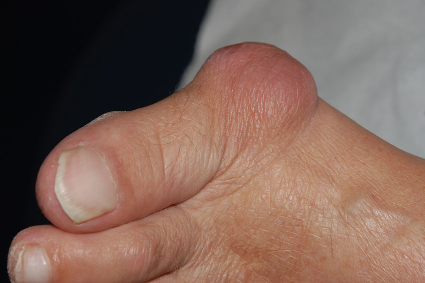 bunion on the big toe