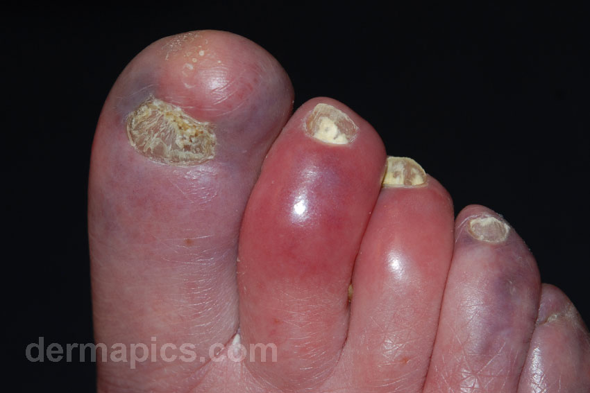 chilblains (feet, red swollen toes)