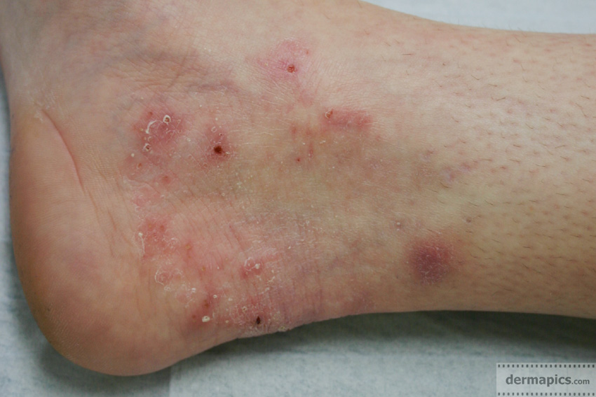 Superficial Mycosis | Fungus