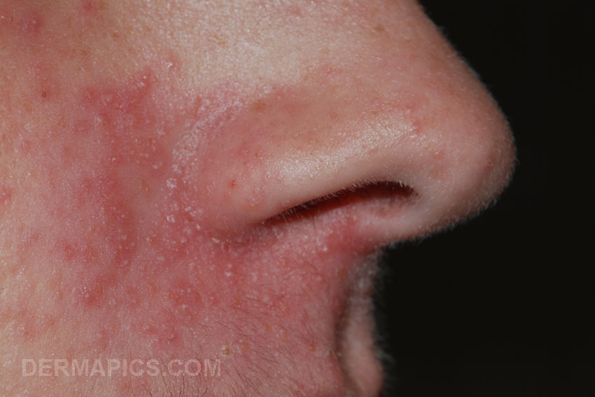 perioral
                      dermatitis (nose)
