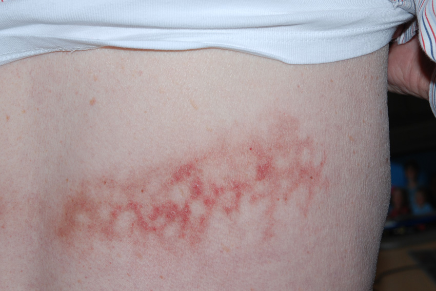 Erythema Ab Igne - American Osteopathic College of ...