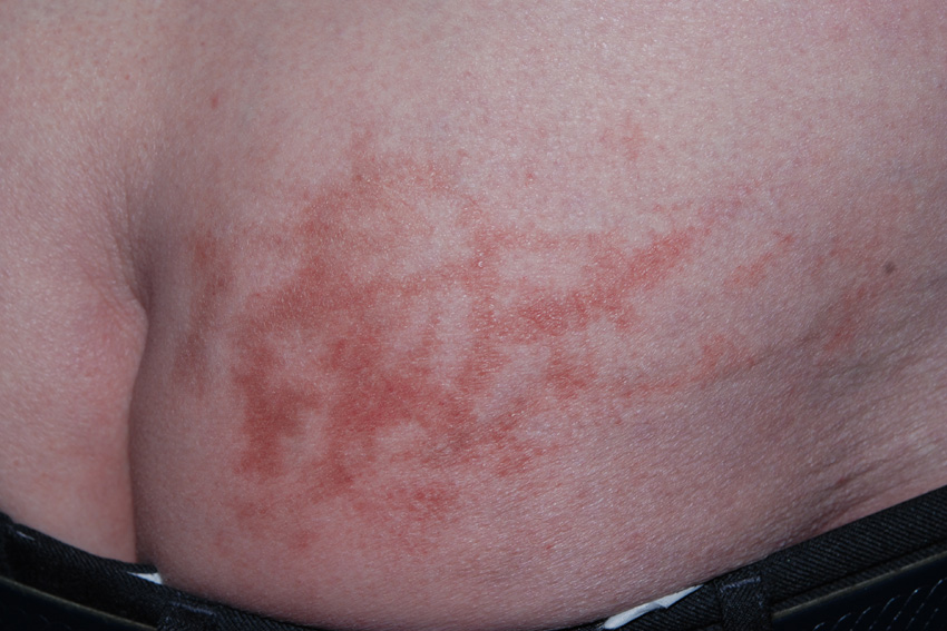 Erythema ab igne of kachelbenen: symptomen en behandeling