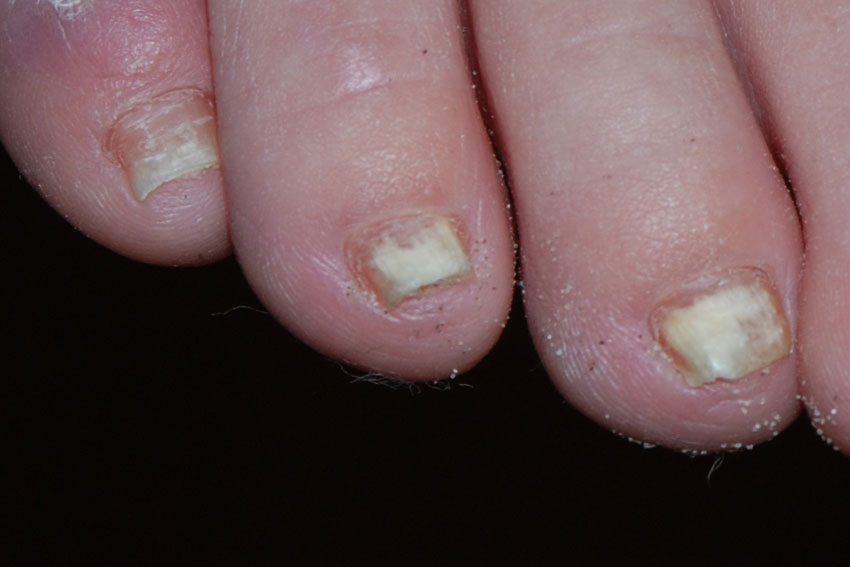 granuloma annulare looking like warts on the hand
