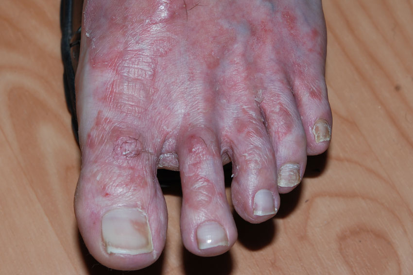 skin mycosis and fungal nail infection