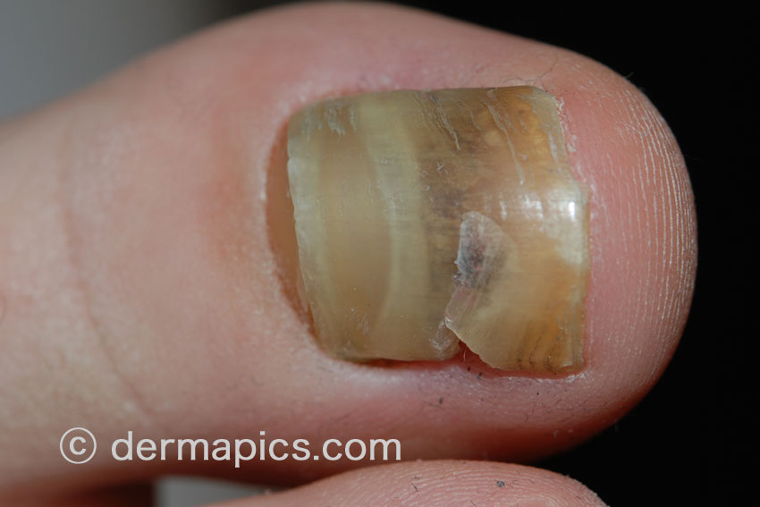 fungal toe nail infection