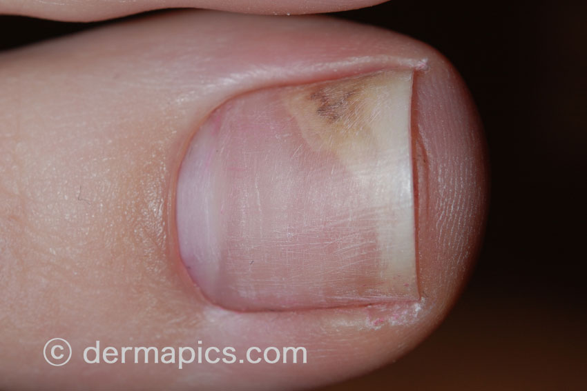 Big toe infection - RightDiagnosis.com