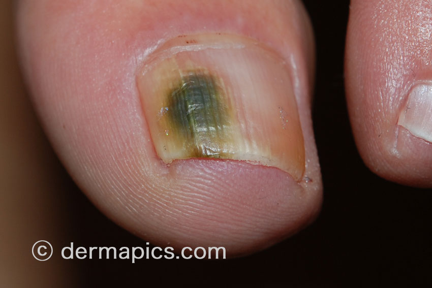 nail infection pictures