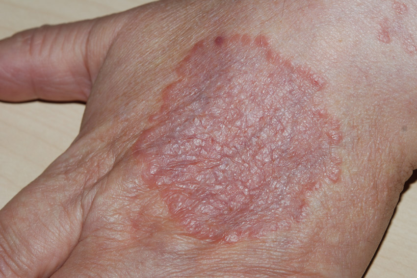 granuloma annulare on the back of the hand