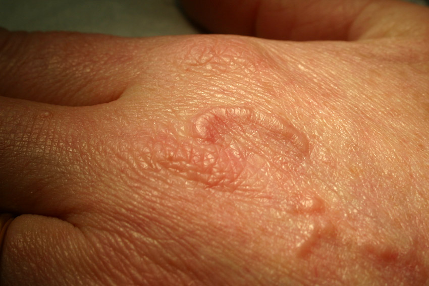 granuloma annulare on the back of the hand