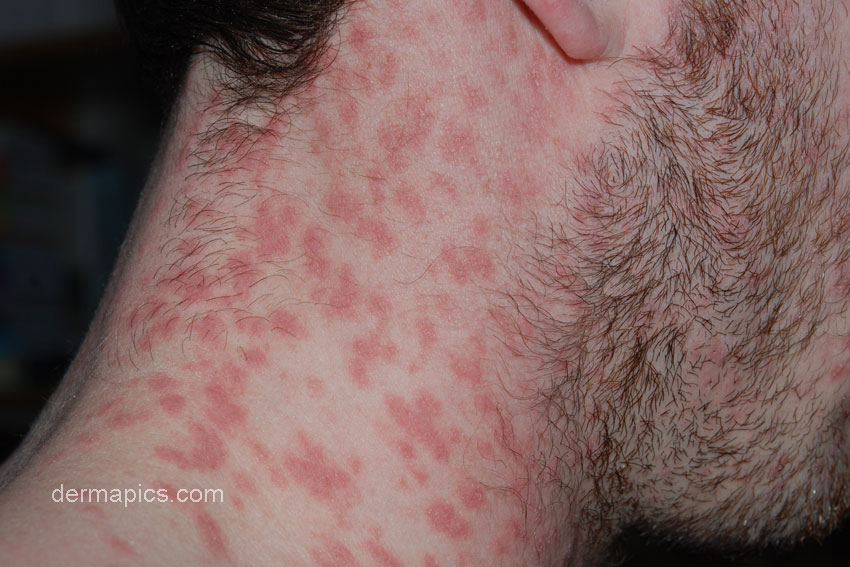 guttate psoriasis