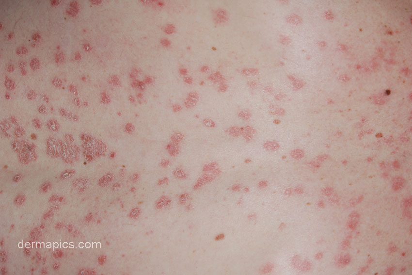 erythema ab igne