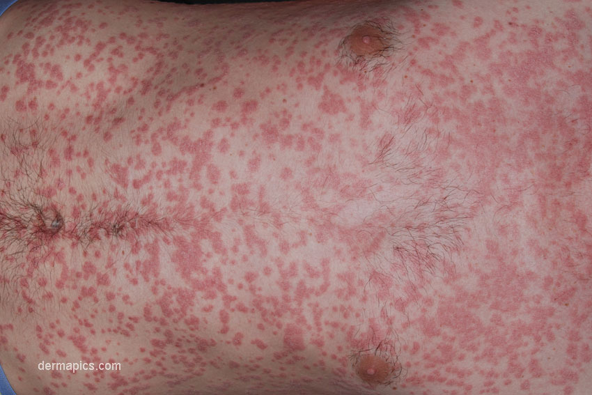 widespread guttate psoriasis