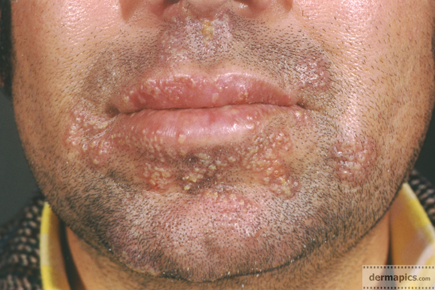 herpes around the mouth