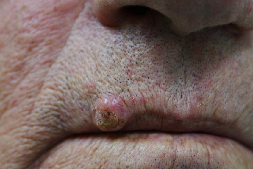 keratoacanthoma on the lip