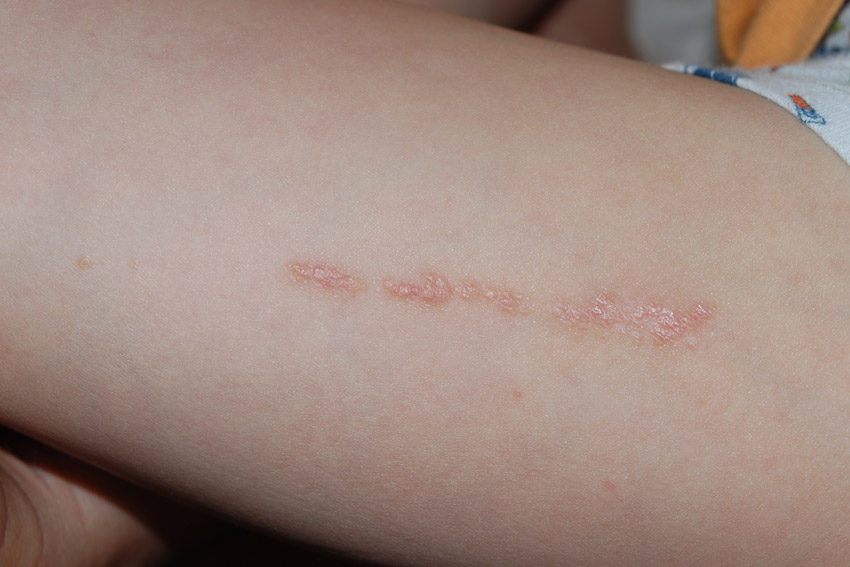 Rash on Arms and Legs - New Health Advisor