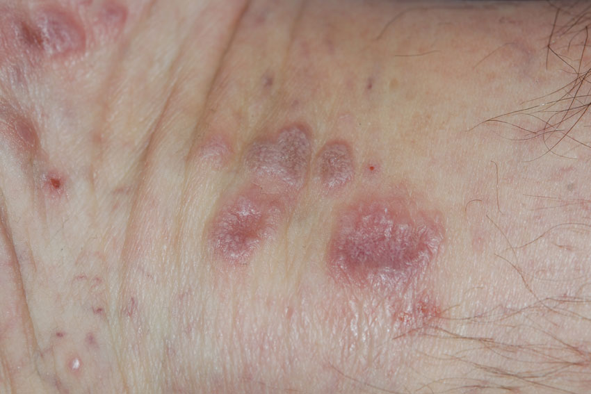 lichen
                      planus on the wrist