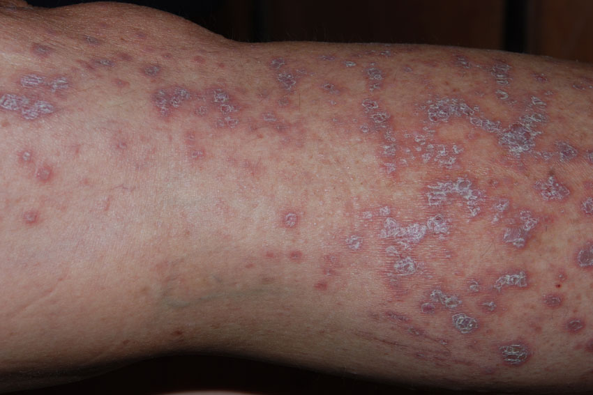 lichen planus on the
                      leg