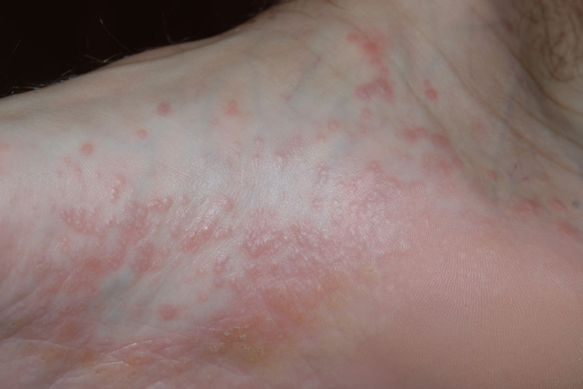 lichen planus