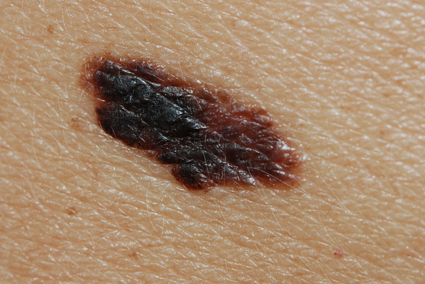 superficial spreading malignant melanoma