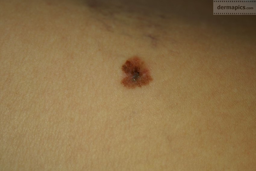 partly nodular melanoma