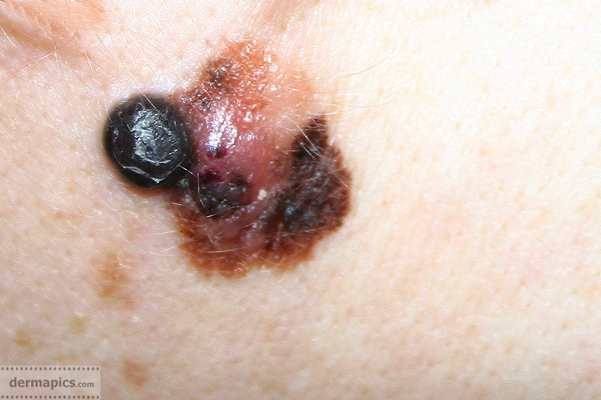 nodular melanoma