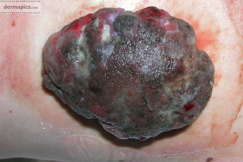 very large nodular melanoma