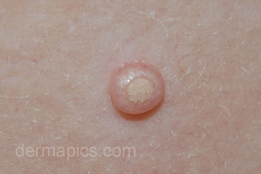 Molluscum Contagiosum Treatment / Conzerol®