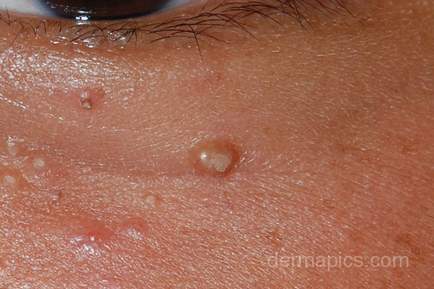 Molluscum contagiosum - Wikipedia