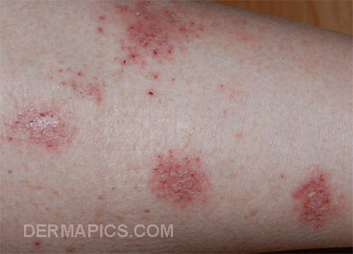 red skin rash: nummular
eczema