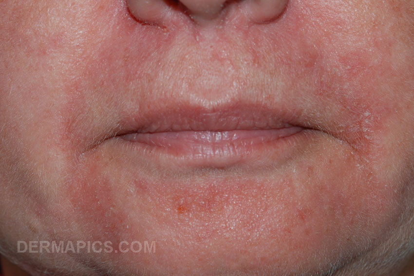 Red Dry Skin Around Mouth 24