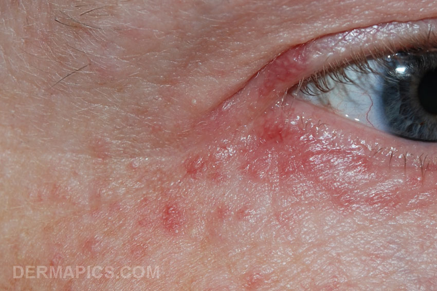 perioral
                      dermatitis (eye)