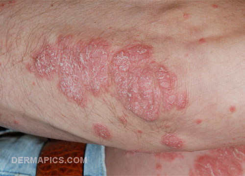 psoriasis_red_rash red spots
and rash: psoriasis