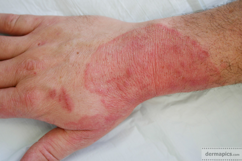 fungal
                      infection (ringworm) of the skin of the hand