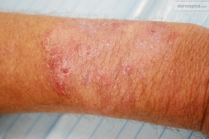 Yeast Fungal Skin Infection Skin Infection Pictures And Treatments