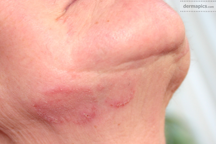 Facial Fungal Rash 56