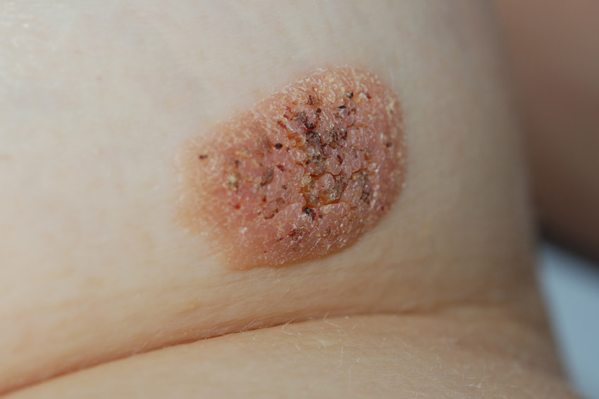 senile wart on the breast