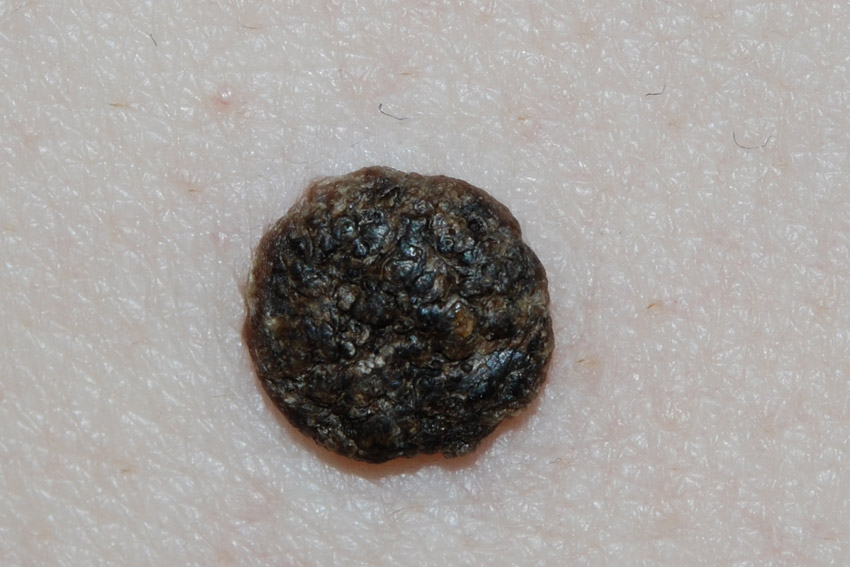 dark senile wart
