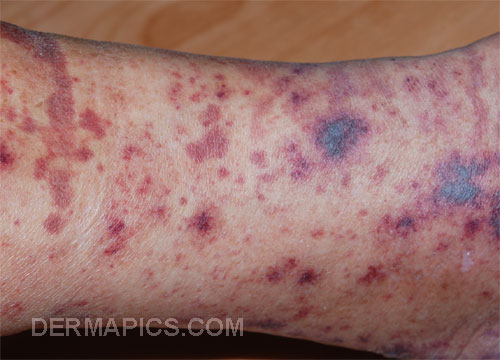 rheumatoid rashes #10