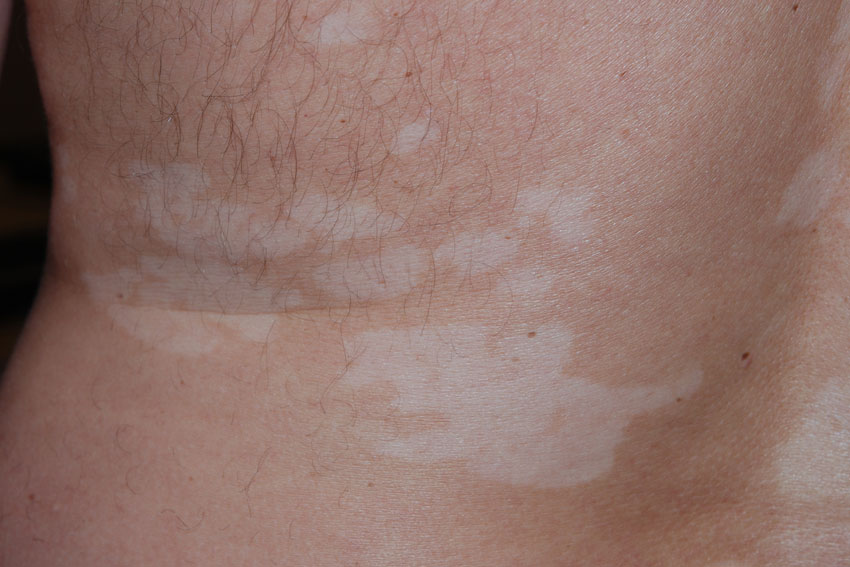 vitiligo