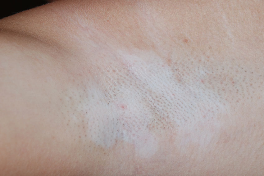 vitiligo in the arm
                      pit