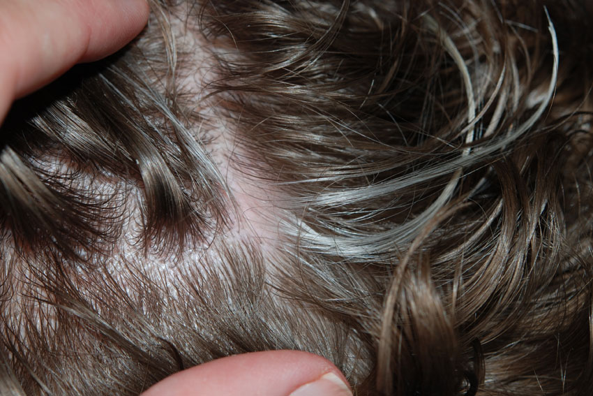 vitiligo on the scalp
                      (white hairs)