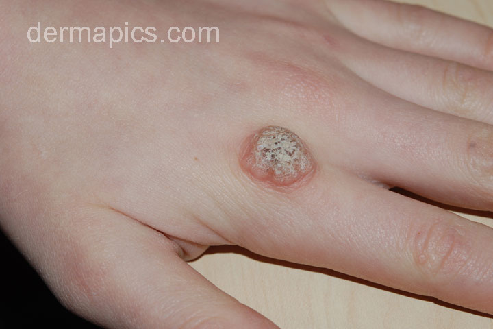 wart on
the hand