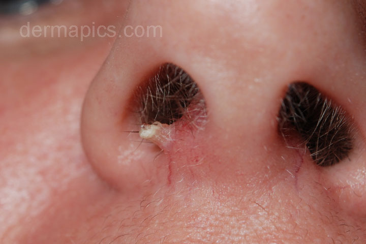 wart in the nose