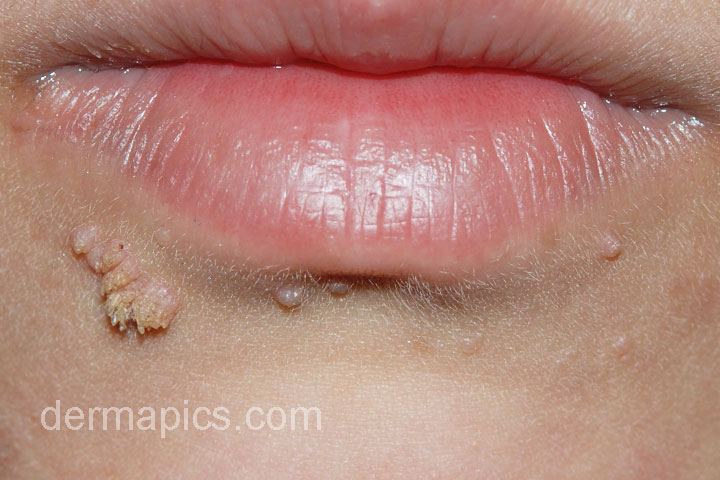 common wart near the
                      lip