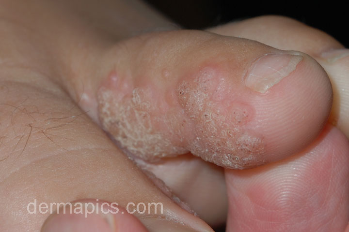 wart
                      between toes