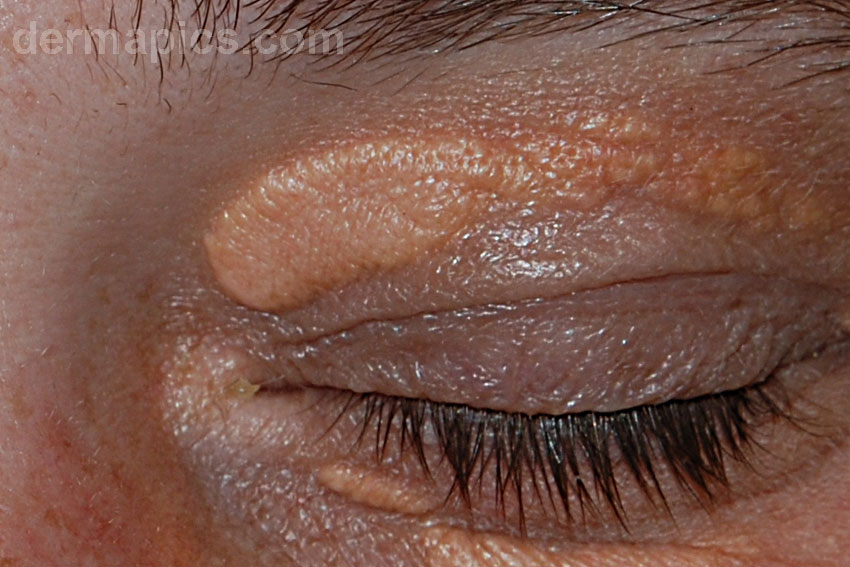 xanthelasma (yellow eyelids)