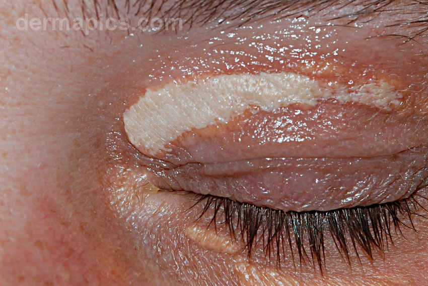 xanthelasma
                      immediately after treatment with trichloroacetic
                      acid solution