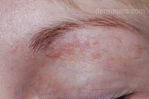 flat warts verruca plana face