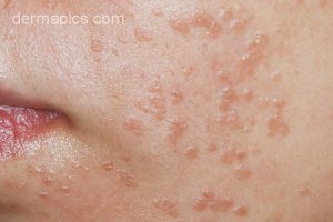 flat warts verruca plana